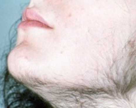turmeric for hirsutism